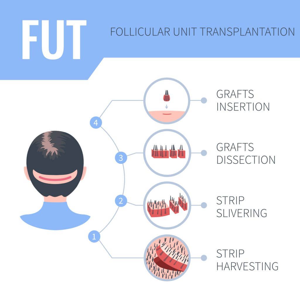 Μέθοδος Μεταμόσχευσης FUT